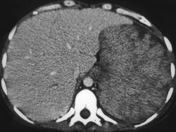 Acute Myelogenous Leukemia - CTisus CT Scan