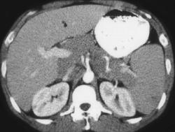 Lymphoma Involves Spleen With Adenopathy - CTisus CT Scan