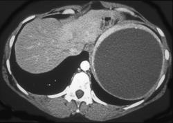 Splenic Cyst (epithelial) - CTisus CT Scan