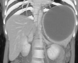 Splenic Cyst - CTisus CT Scan