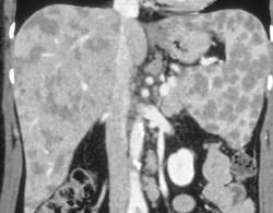 Sarcoidosis - CTisus CT Scan