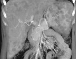 Sarcoidosis - CTisus CT Scan