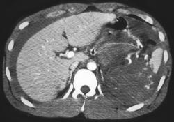 Splenic Laceration and Infarct - CTisus CT Scan