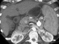 Splenic Artery Aneurysm - CTisus CT Scan