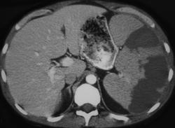 Splenic Infarcts - CTisus CT Scan