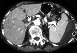 Splenic Lacerations & Subcapsular Bleed - CTisus CT Scan