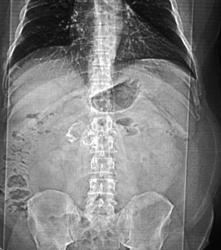 Splenic Artery Aneurysm - CTisus CT Scan