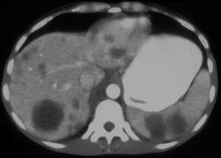 Metastases to the Speen and Liver - CTisus CT Scan