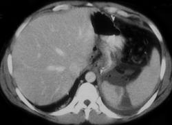 Splenic Laceration - CTisus CT Scan