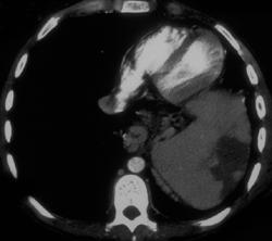 Cystic Fibrosis With Splenic Infarct - CTisus CT Scan