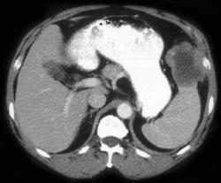 Lymphoma - CTisus CT Scan