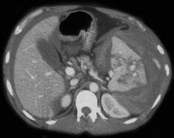 Splenic Laceration With Hematoma - CTisus CT Scan