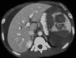 Splenic Laceration - CTisus CT Scan