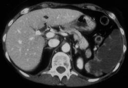 Splenic Infarction - CTisus CT Scan