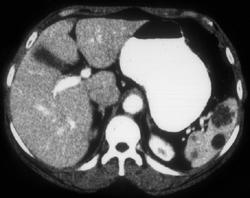 Splenic Hemangiomas - CTisus CT Scan