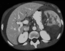 Splenic Laceration - CTisus CT Scan