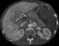 Splenic Infarct With Portal Vein and Splenic Vein Thrombosis - CTisus CT Scan