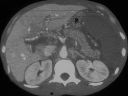 Portal Vein & Splenic Vein Occlusion & Splenic Infarct - CTisus CT Scan