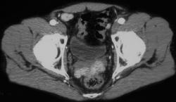 Accessory Spleens in the Pelvis (hx of Trauma and Splenic Rupture) - CTisus CT Scan