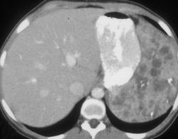 Splenic Hemangiomas - CTisus CT Scan