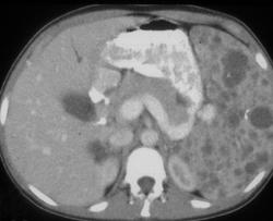 Hemangiomas Spleen in Patient With Hemangiomatosis - CTisus CT Scan