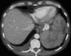 Splenic Infarcts and Abscess - CTisus CT Scan