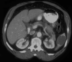 Epidermoid Cyst - CTisus CT Scan