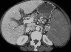 Splenic Lymphoma - CTisus CT Scan