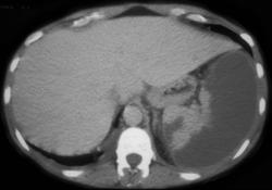 Splenic Infarction - CTisus CT Scan