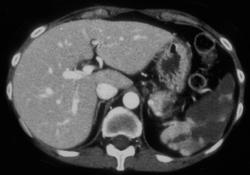 Splenic Infarcts - CTisus CT Scan