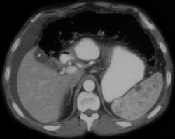 Splenic Hemangiomas - CTisus CT Scan