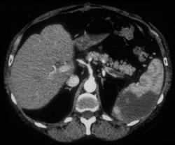 Splenic Vein Thrombosis and Splenic Vein Clot - CTisus CT Scan