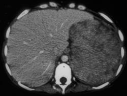 Angiomyolipoma (AML) - CTisus CT Scan