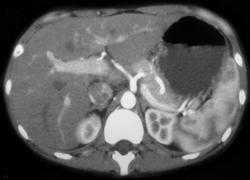 Normal Adrenal Phase Imaging of the Spleen - CTisus CT Scan