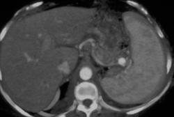 Splenic Artery Aneurysm - CTisus CT Scan