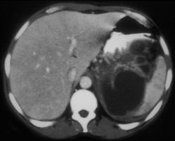 Pseudocyst Extends Into the Spleen - CTisus CT Scan