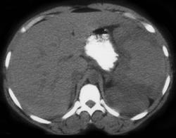 Splenic Sequestration - CTisus CT Scan