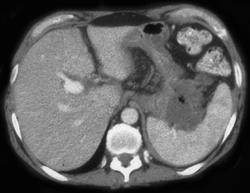 Pseudocyst Extends Into Splenic Hilum - CTisus CT Scan