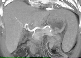 Sarcoidosis - CTisus CT Scan