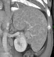 Sarcoidosis - CTisus CT Scan