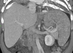 Sarcoidosis - CTisus CT Scan