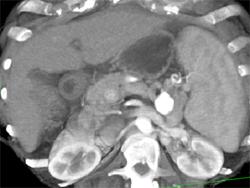 Splenic Artery Aneurysm - CTisus CT Scan