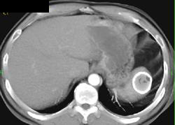 Splenic Cyst - CTisus CT Scan