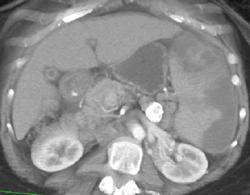 Splenic Infarcts - CTisus CT Scan