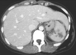 Splenic Infarcts/abscess - CTisus CT Scan