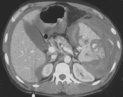 Active Bleed From Spleen - CTisus CT Scan