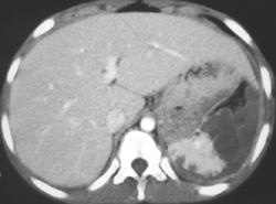 Infarcted Spleen - CTisus CT Scan