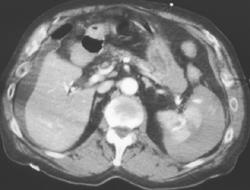 Splenic Laceration and Bleed - CTisus CT Scan