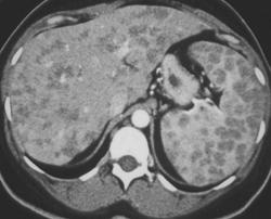 Sarcoidosis - CTisus CT Scan