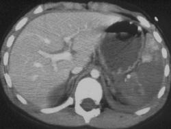 Splenic Laceration and Renal Artery Avulsion - CTisus CT Scan